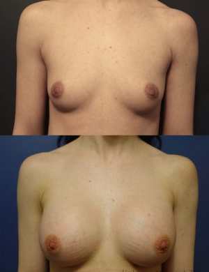 26-breast-augmentation-before-after