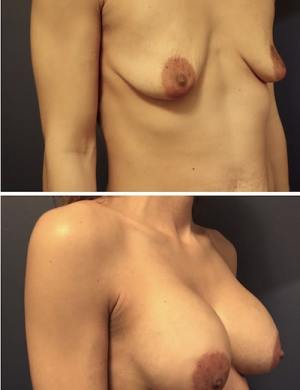 27-breast-augmentation-before-after