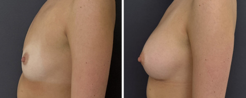 30-breast-augmentation-before-after