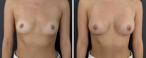 31-breast-augmentation-nyc-before-after-1-1