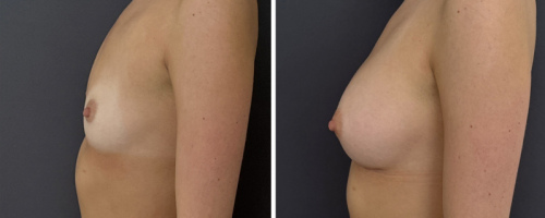 31-breast-augmentation-nyc-before-after-1-2