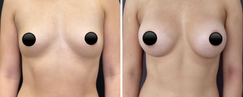 34-breast-augmentation-plastic-surgery-nyc-before-after-1-1