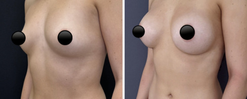 34-breast-augmentation-plastic-surgery-nyc-before-after-1-2