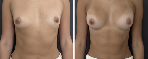 35-breast-augmentation-plastic-surgery-nyc-before-after-1-1