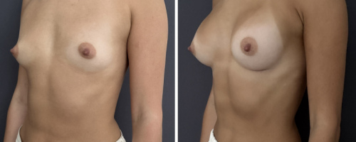 35-breast-augmentation-plastic-surgery-nyc-before-after-1-2