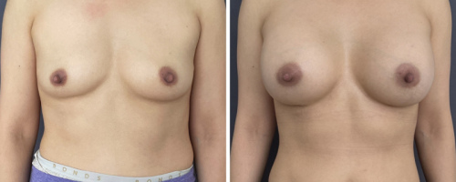 36-breast-augmentation-plastic-surgery-nyc-before-after-1-1