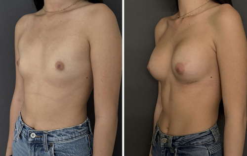 37-breast-augmentation-plastic-surgery-nyc-before-after-1-1