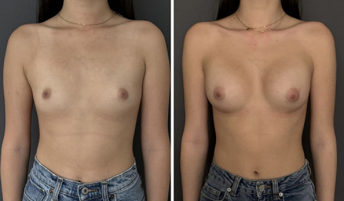 37-breast-augmentation-plastic-surgery-nyc-before-after-1-2