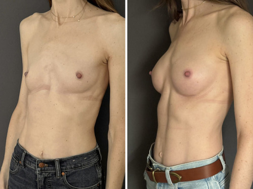 40-breast-augmentation-plastic-surgery-nyc-before-after