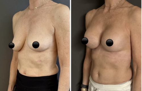 41-breast-augmentation-plastic-surgery-nyc-before-after-1-2