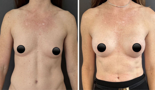 41-breast-augmentation-plastic-surgery-nyc-before-after-10