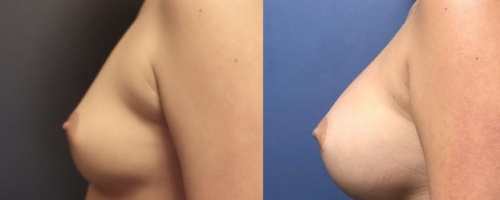 9-breast-augmentation-before-after