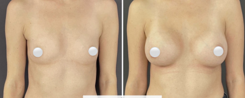 Breast-augmentation-before-and-after-photo-032723-1