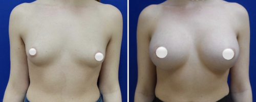 breast-augmentation-before-after-3