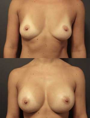breast-augmentation-before-after-4
