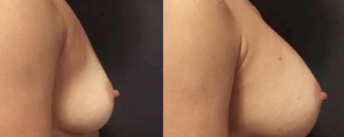 breast-augmentation-before-after-5