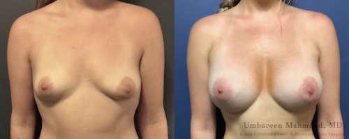 breast-augmentation-before-after-6