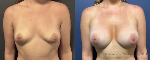 breast-augmentation-before-after-6