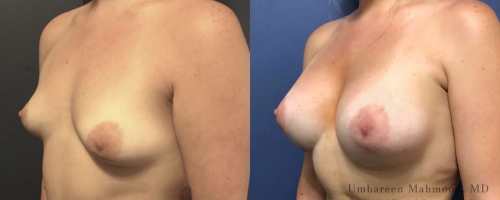breast-augmentation-before-after-7