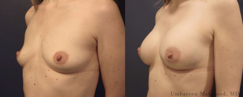 breast-augmentation-before-after-8