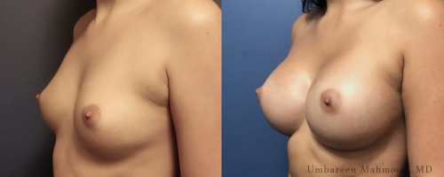 breast-augmentation-before-after-9