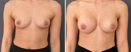 breast-augmentation-before-after