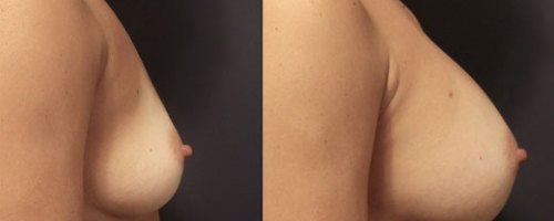 breast-augmentation-female-profile