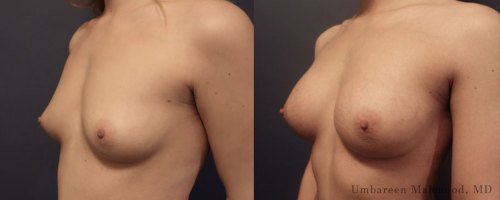 breast-augmentation-female