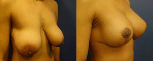 before-after-female-4-breast-lift-min
