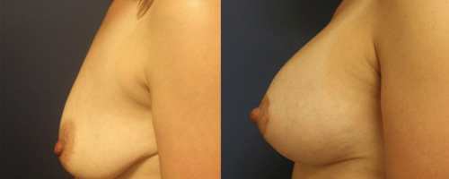before-after-female-5-breast-lift-profile-min