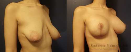 before-after-female-6-front-breast-lift-min