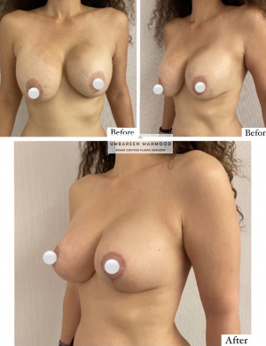 breast-augmentation-mastopexy-before-after-1