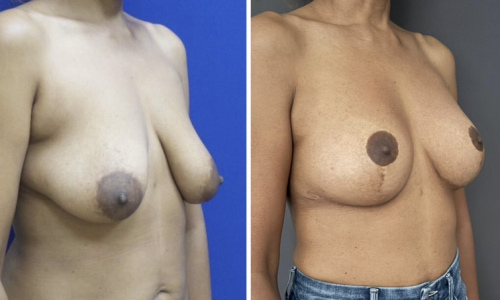 breast-lift-implants-plastic-surgeon-nyc-before-after-1-1