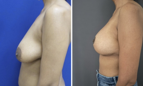 breast-lift-implants-plastic-surgeon-nyc-before-after-1-2