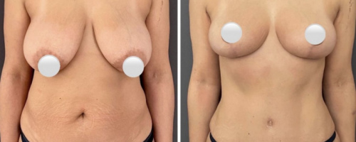 1_before-after-breast-lift-7