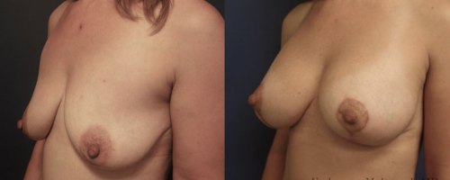 Breast-lift