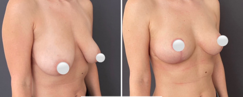 Mastopexy-before-and-after-photo-032723-1