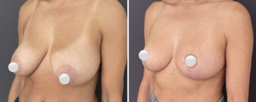 before-after-breast-lift-10