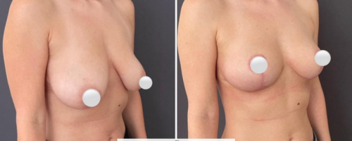 before-after-breast-lift-11