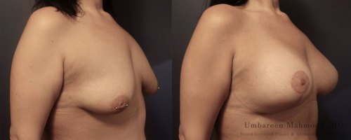 before-after-breast-lift-3