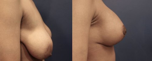 before-after-breast-lift-6