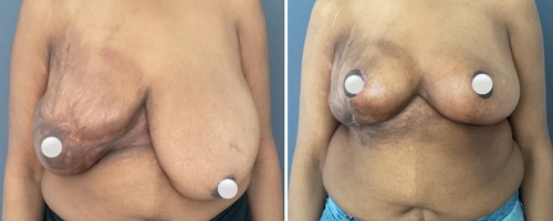 before-after-breast-lift-7