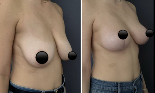 before-after-breast-lift-plastic-surgery-nyc-12