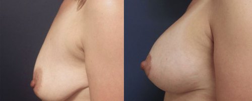 before-after-breast-lift