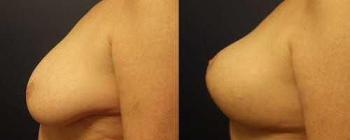 breast-lift-before-after-profile