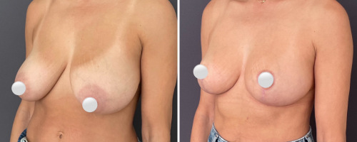 mastopexy-no-implants-before-after