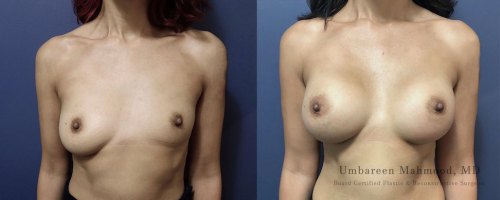 Before-After-Breast-Reconstruction-2