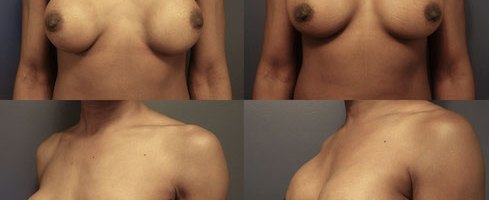 Before-After-Breast-Reconstrution-3