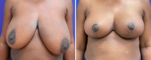 Before-AFter-Breast-Reduction-14