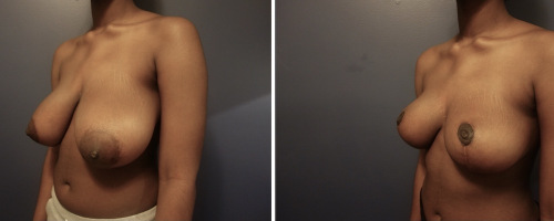 Before-AFter-Breast-Reduction-with-Lift-10